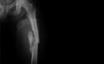 Диафизарные переломы бедренной кости Прогноз диафизарных переломов костей голени
